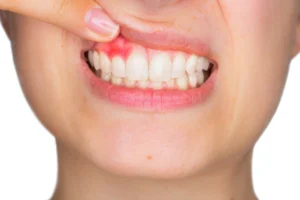 Malattie gengivali: diagnosi, cause, sintomi, cure