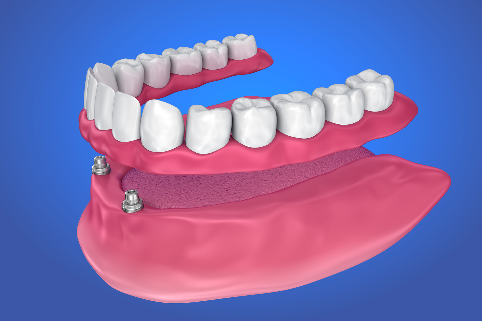 impiantologia dei denti