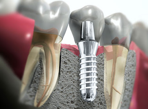 impianto denti