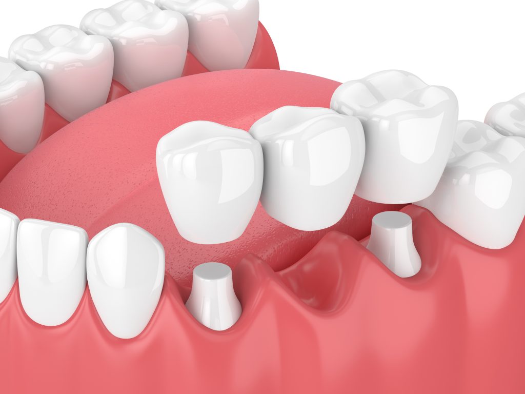 impianti denti 