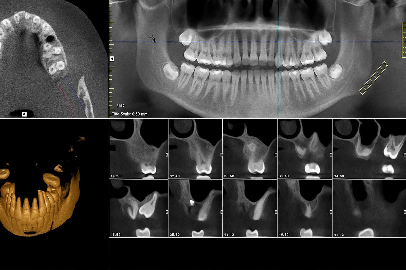 Tac denti 3d